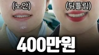 thumb 2038849015 nBQIhalv d4a2acb1c28158e892baafa7e3ad6568ec2289c0 315x176 — 루센트치과의원